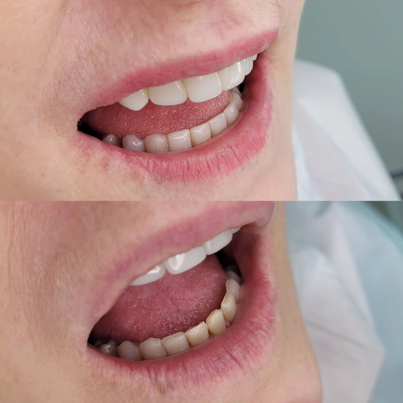 Antes e depois — Recobrimento Radicular