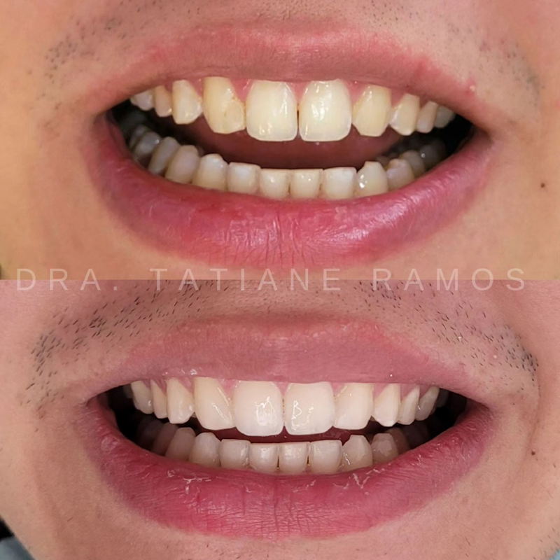 Antes e depois — Tratamento Periodontal