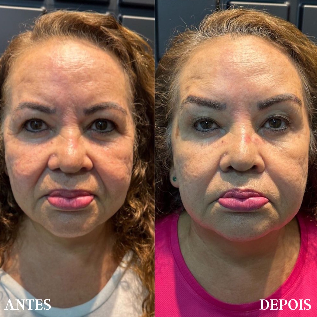 Harmonização Facial